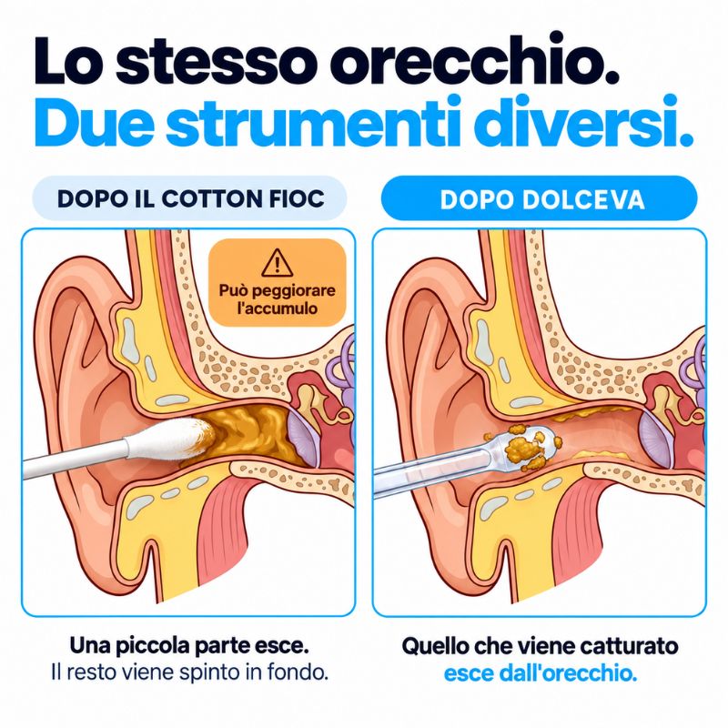 Dolceva® Pulisci-orecchie adesivo – Cattura il cerume invece di spingerlo in fondo